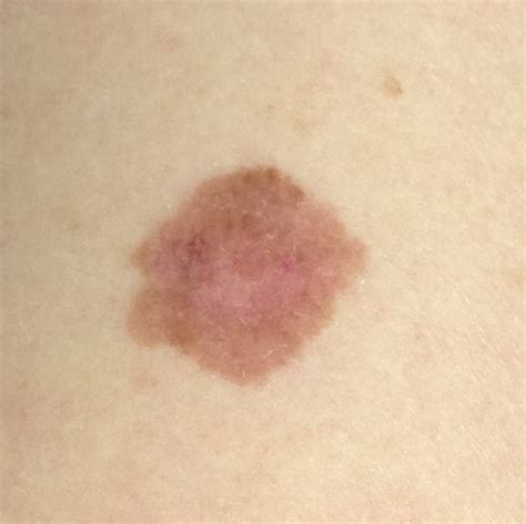 melanoma spot on arm